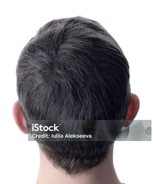 Clinic 25 hair transplant after2