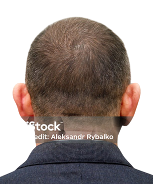 Clinic 23 hair transplant after3 Photoroom