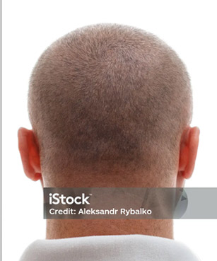 Clinic 27 hair transplant after4