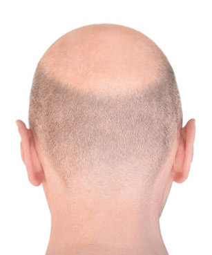 Clinic 22 hair transplant before