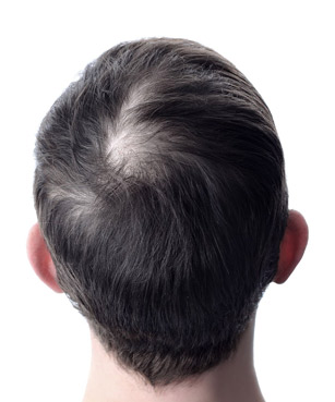 Clinic 26 hair transplant before2