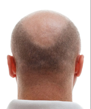 Clinic 28 hair transplant before4